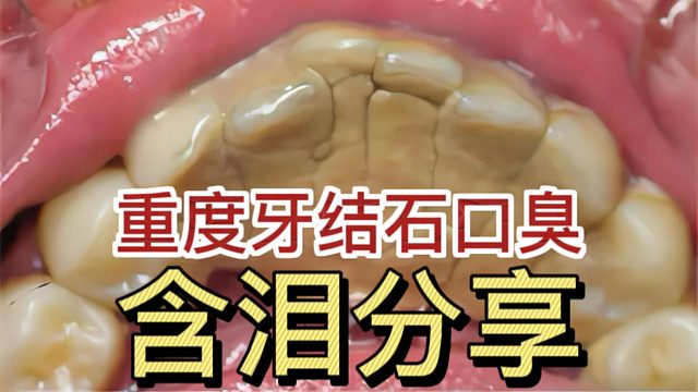 多年牙结石口臭终于清除！过来人血泪经验大曝光！早学早受益！