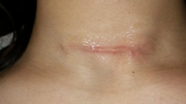 后悔没有早点知道！陈年老疤去除竟然只用它们！赶紧收藏抄作业！