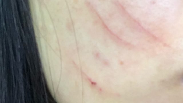 脸上疤痕太自卑？没想到这么简单就能轻松去除！简直好用到哭！