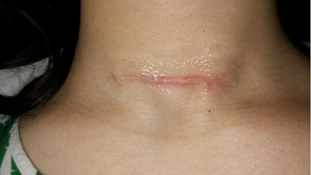 真的很牛啊啊啊！两个月去除术后疤痕！竟然只用了它们！