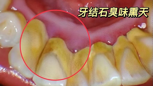 牙结石口臭不要傻傻洗牙！过来人自爆低成本方法！用过早好了！