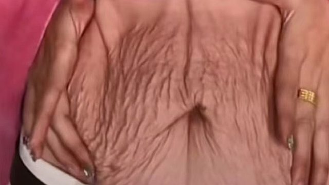 长了肥胖纹不用愁！3个方法教你在家解决！纹路悄悄淡化消失！