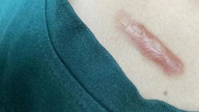 判断疤痕是否增生？怎么去除？跟着上岸人员十分钟轻松祛疤不留痕！