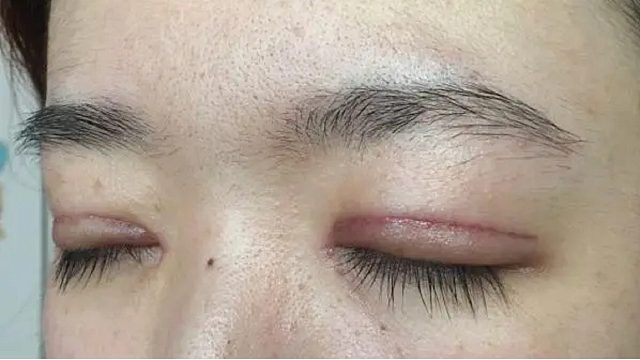 双眼皮留疤怎么办？这两个步骤坚持做疤痕全消！保证有效！