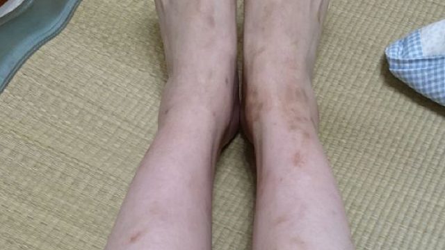 疤痕体质太烦恼？跟着过来人做完这些！疤痕想不去掉都难！