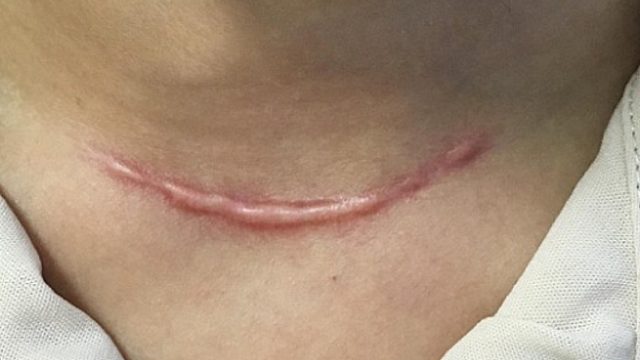 快记笔记低成本祛疤妙招！彻底告别烦人疤痕！还你健康光滑皮！