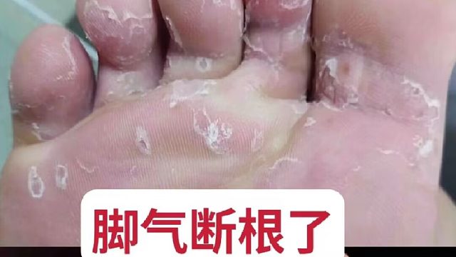 揭秘脚气王上岸秘方！看到就是赚到！