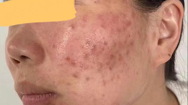 痘印太难祛除？教你3个简单去痘印妙招！赶紧学起来！