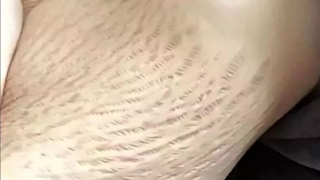 对抗妊娠纹别乱用偏方了！一分钟教会你！在家轻松紧致嫩肤！