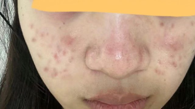 进来听劝！上岸者的干货分享！用对方法满脸痘印直接抹没！