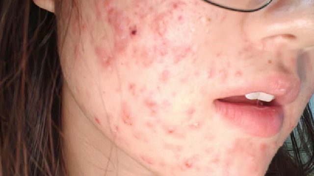 6年的重度痤疮终于痊愈！过来人祛痘妙招分享！40天红肿痘痘全消！