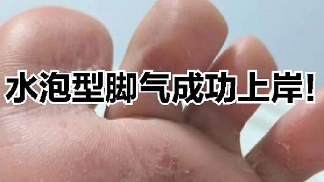 脚气王的救星！脚臭脚汗这样做轻松搞定！