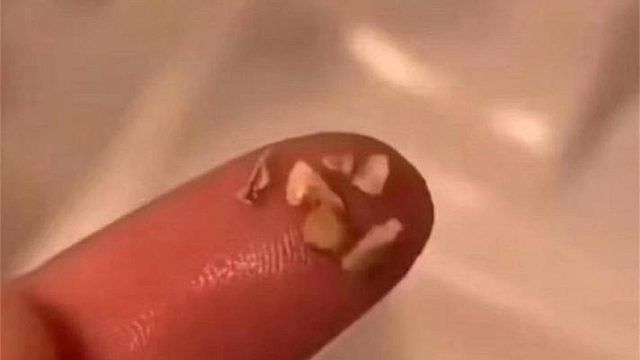 不洗牙解决牙结石口臭！过来人的方法太牛了！赶紧收藏！