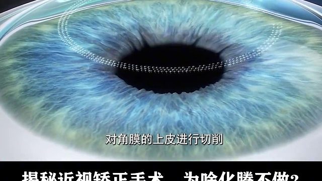近视矫正手术这么成熟？为什么眼科医生、马化腾，还戴着眼镜2