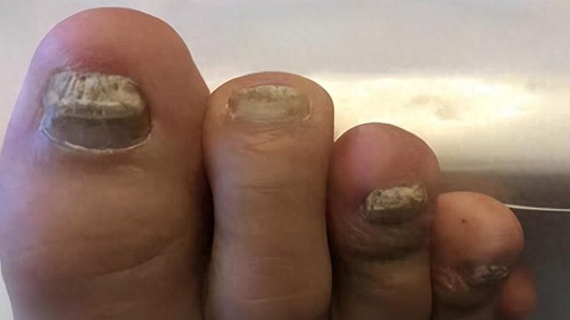 灰指甲产品大测评！这些洋货快扔了吧！国货才是最牛的！