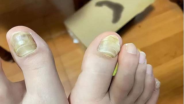灰指甲久治不愈？这个方法跟着做，在家轻松治愈不复发！