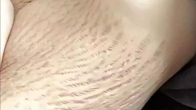 6年妊娠纹还能去除吗？这5个步骤每天做！多顽固的纹路都能消！