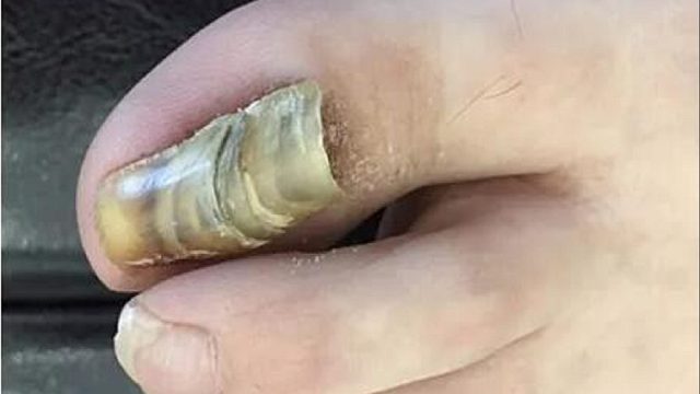 灰指甲如何根治不反复？被追着问的祛灰秘籍来了！学会直省大几千！