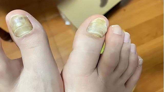 不花一份冤枉钱在家治好灰指甲！方法简单好操作，学会直省大几千！
