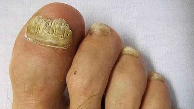 得了灰指甲怎么治？康复者曝光自用秘籍，杀菌修复不反灰！