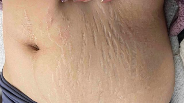 淡纹产品怎么选？宝妈亲测有效的3款分享！红白纹自行消失！