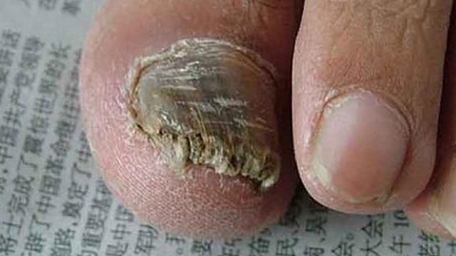 天热灰指甲又复发？过来人3招教你解决！灰指甲秒变健康新甲！