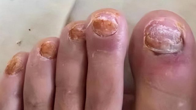 真菌感染的灰指甲怎么治？4个国货祛灰产品快用！杀菌修复不反灰