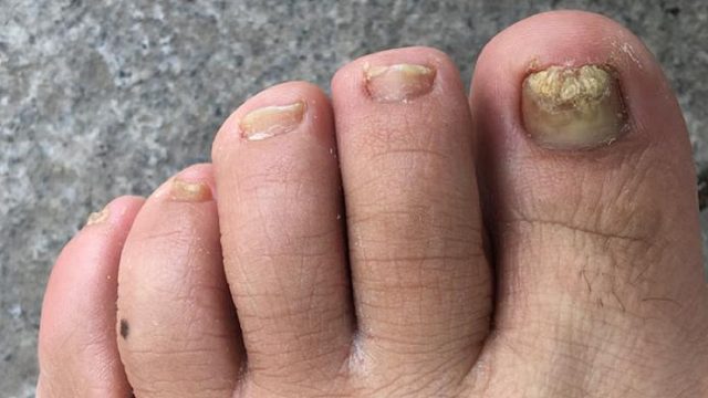 灰指甲抑菌产品怎么选？别只知道亮甲了！这几个国货效果更好！