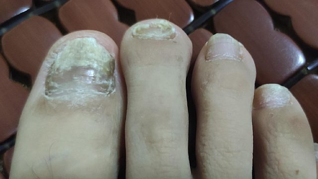 灰指甲怎么才能根除？不妨试试碘伏加它，泛黄增厚指甲秒没！