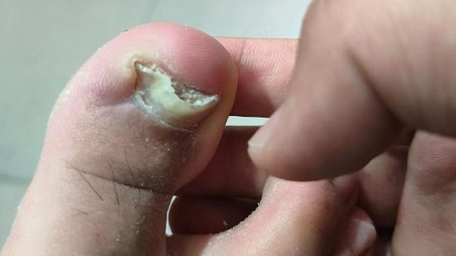 指甲发黄增厚还变形！2个方法教你在家根治！安全有效又省钱！
