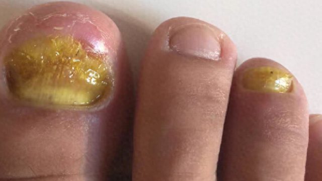天一热灰指甲又复发？学会这招，在家轻松摆脱它！