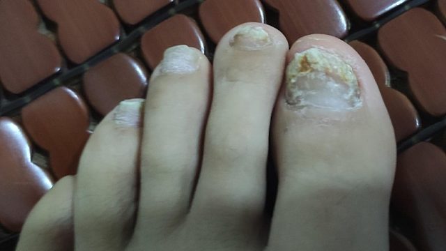 指甲发黄增厚有救了！这5个步骤跟着做，顽固灰甲秒变新甲！