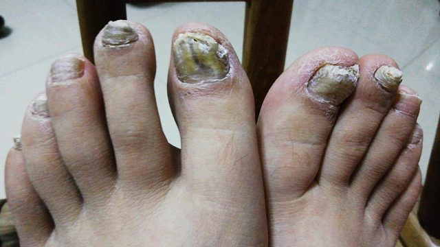 灰指甲又厚又硬还发痒？学会这3招，不花冤枉钱在家根治它！