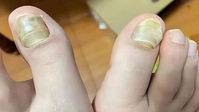 灰指甲别乱用药了！康复者分享3款自用产品！任用一个坏甲变亮甲！