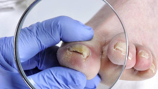 灰指甲抑菌药物大测评！黄厚病甲随便一涂就没！每天几毛钱！