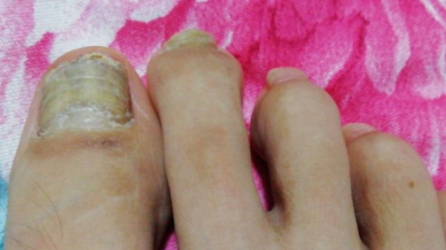 得了灰指甲，一个传染俩！别慌！康复者手把手教你解决！