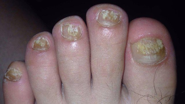 别再乱用偏方了！学会这3个杀菌妙招，灰指甲在家根治不反复！