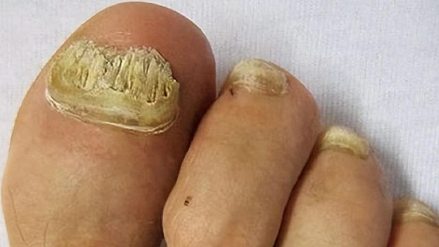 4年顽固灰指甲一招根除！过来人曝光自用秘籍！每天只需几毛钱！