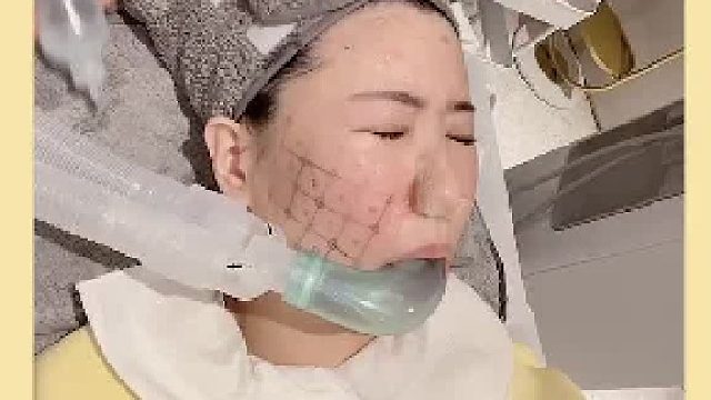 眼部热玛吉和脸部热玛吉一起上有多疼？？