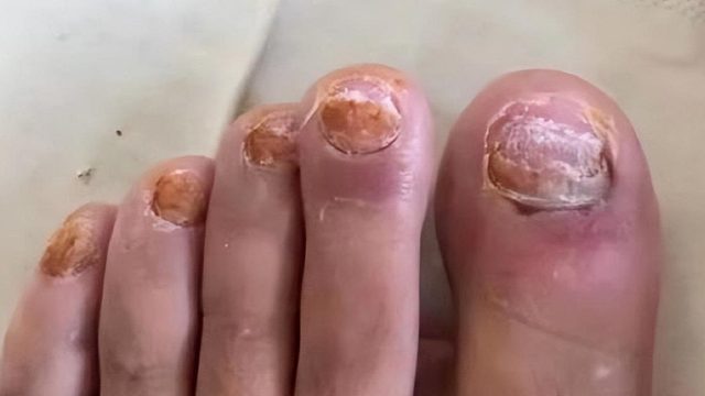 灰指甲顽固太难治？选对抑菌产品！黄厚病甲秒变光洁新甲！