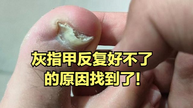 灰指甲反反复复好不了？原因终于找到了！（附最佳根治妙招）