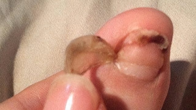 灰指甲别再拖了！教你一招，泛黄增厚的病甲分分钟脱落恢复！