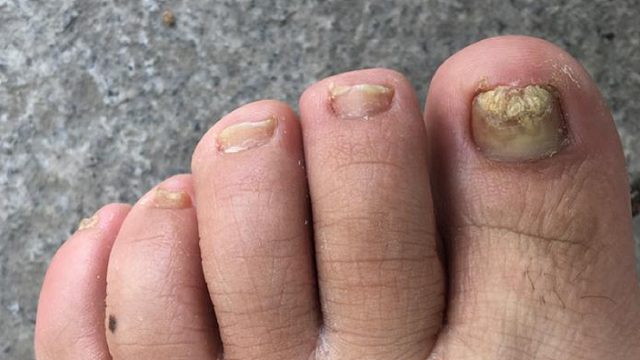 灰指甲真菌如何除？3个绝招，在家轻松搞定不复发！