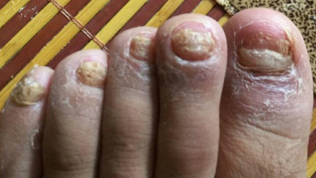 灰指甲最怕的除菌妙招！一个月坏甲唰唰掉！简单方便又省钱！