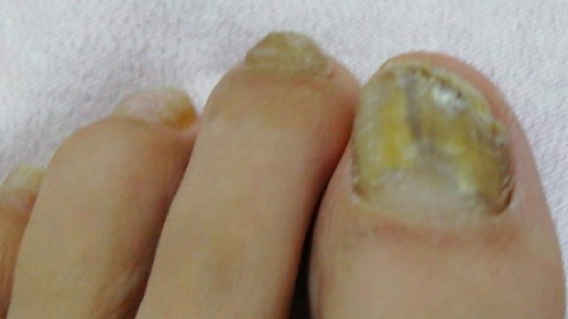 得了灰指甲别乱治！3个方法教你在家摆脱它！学会立省大几千！