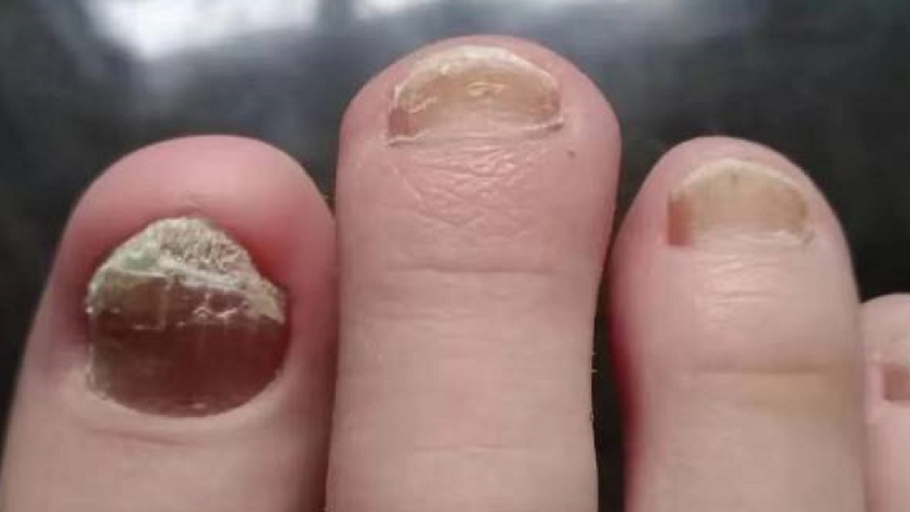 指甲受伤引发灰指甲？学会4招，泛黄增厚的灰指甲秒变健康新甲！