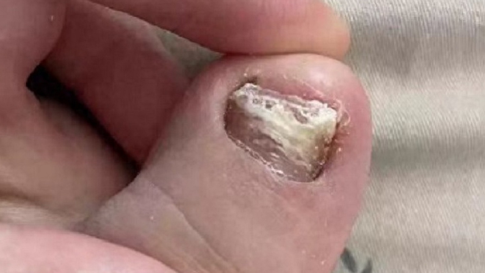 祛灰药物怎么选？过来人分享3款自用！顽固灰指甲说没就没！