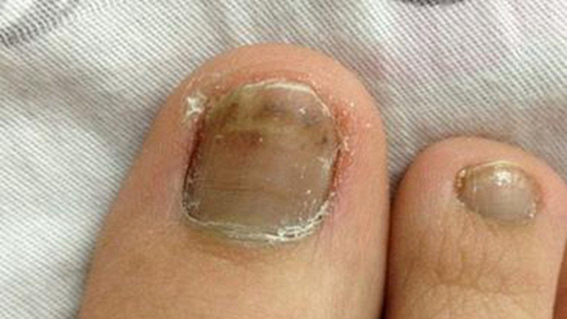 灰指甲详细治疗方案曝光！数万患者抢着用！一个月坏甲自动脱落！