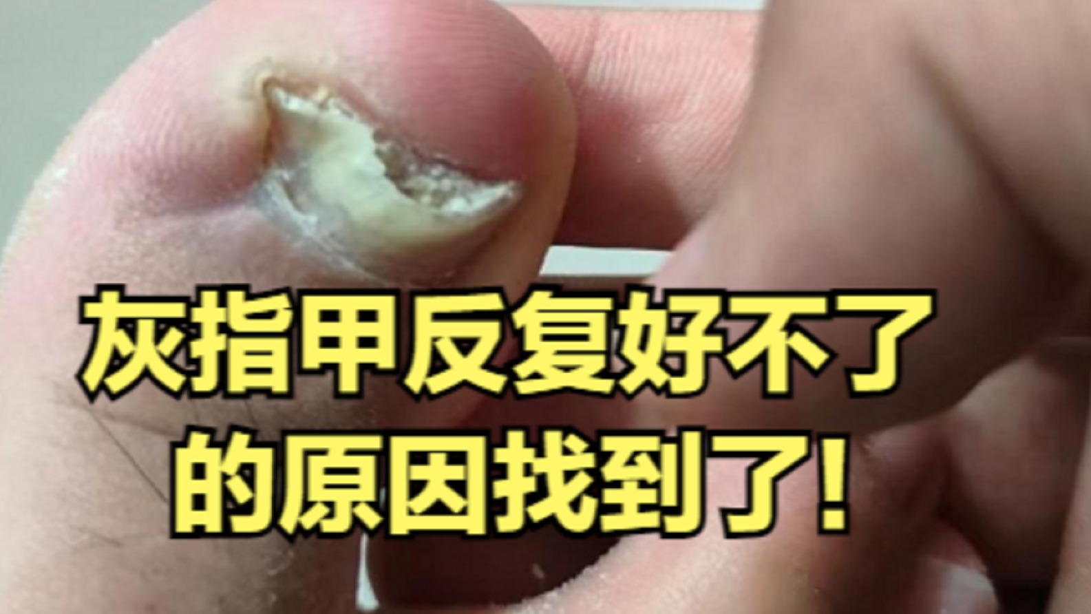 灰指甲反反复复好不了？原因终于找到了！不看必后悔！