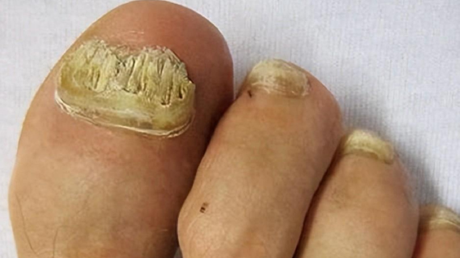 3个月在家摆脱顽固灰甲！方法竟然还有人不知道！看到赶紧收藏！